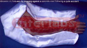 Graze abrasion on the arm following a bicycle accident